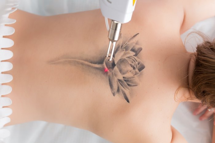 3-Way Tattoo Removal (VTQ)