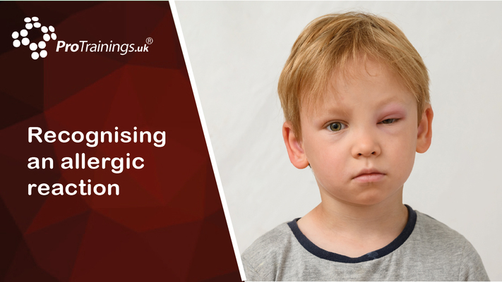 Recognising the signs of an allergic reaction 