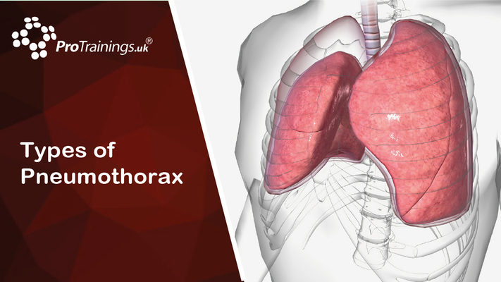 Types of Pneumothorax 