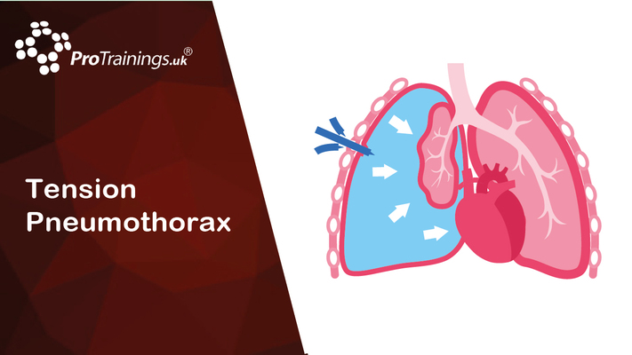 Tension Pneumothorax 