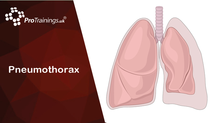 Pneumothorax 