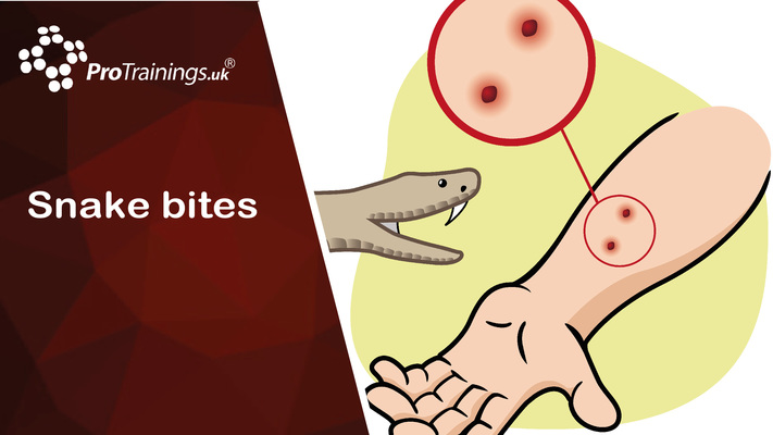 Treating Snake Bites 